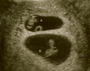 Ultrasound - Twins