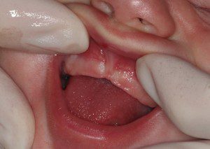 Breastfeeding Battles: Lip and Tongue Ties