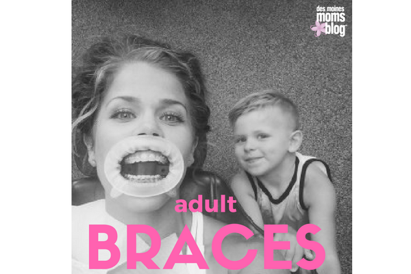 adult braces | des moines moms blog